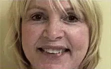 Middle-aged woman smiling before getting dental veneers, showing uneven and discolored teeth