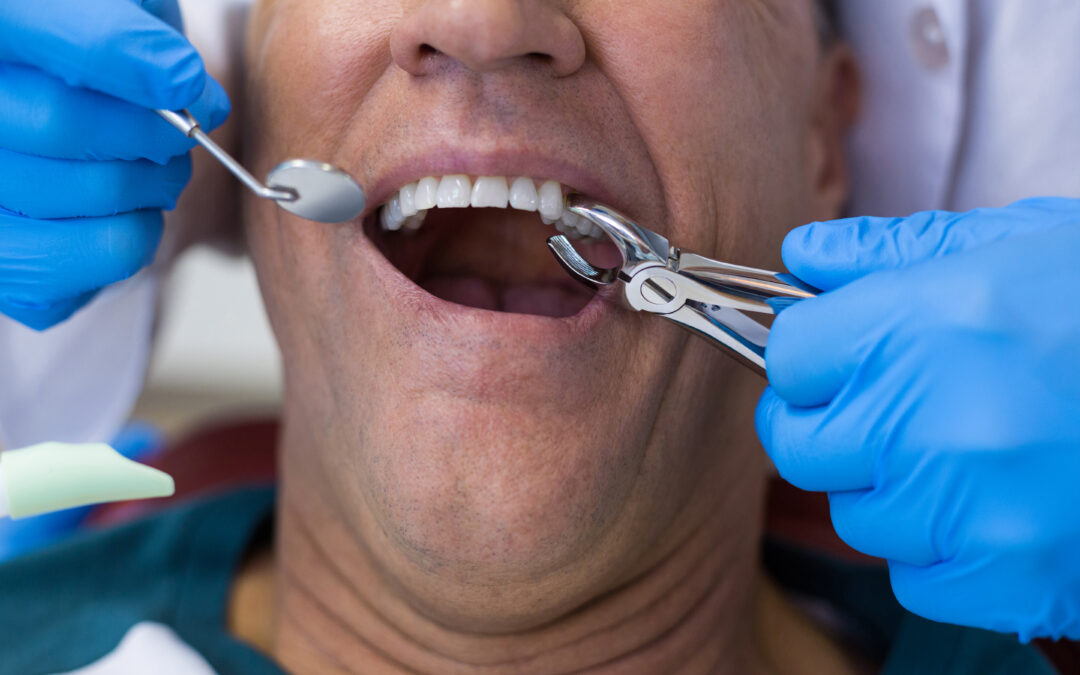 Tooth Extraction: How Soon Should You Replace Missing Teeth?