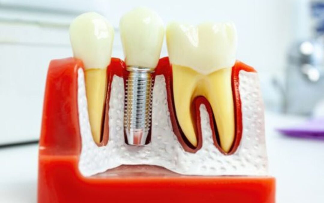Can Dental Implants Cause Metallic Taste in the Mouth?
