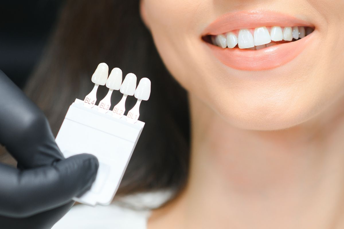 dental veneers