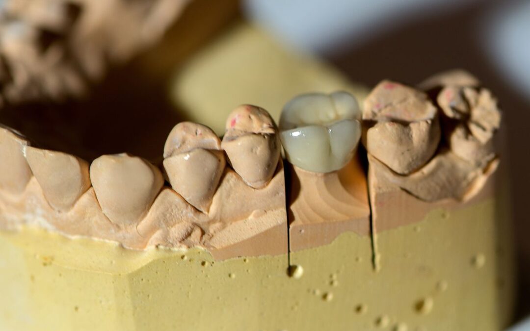 What Should You Do If Your Dental Crown Feels Loose? A Tulsa Dentist Explains