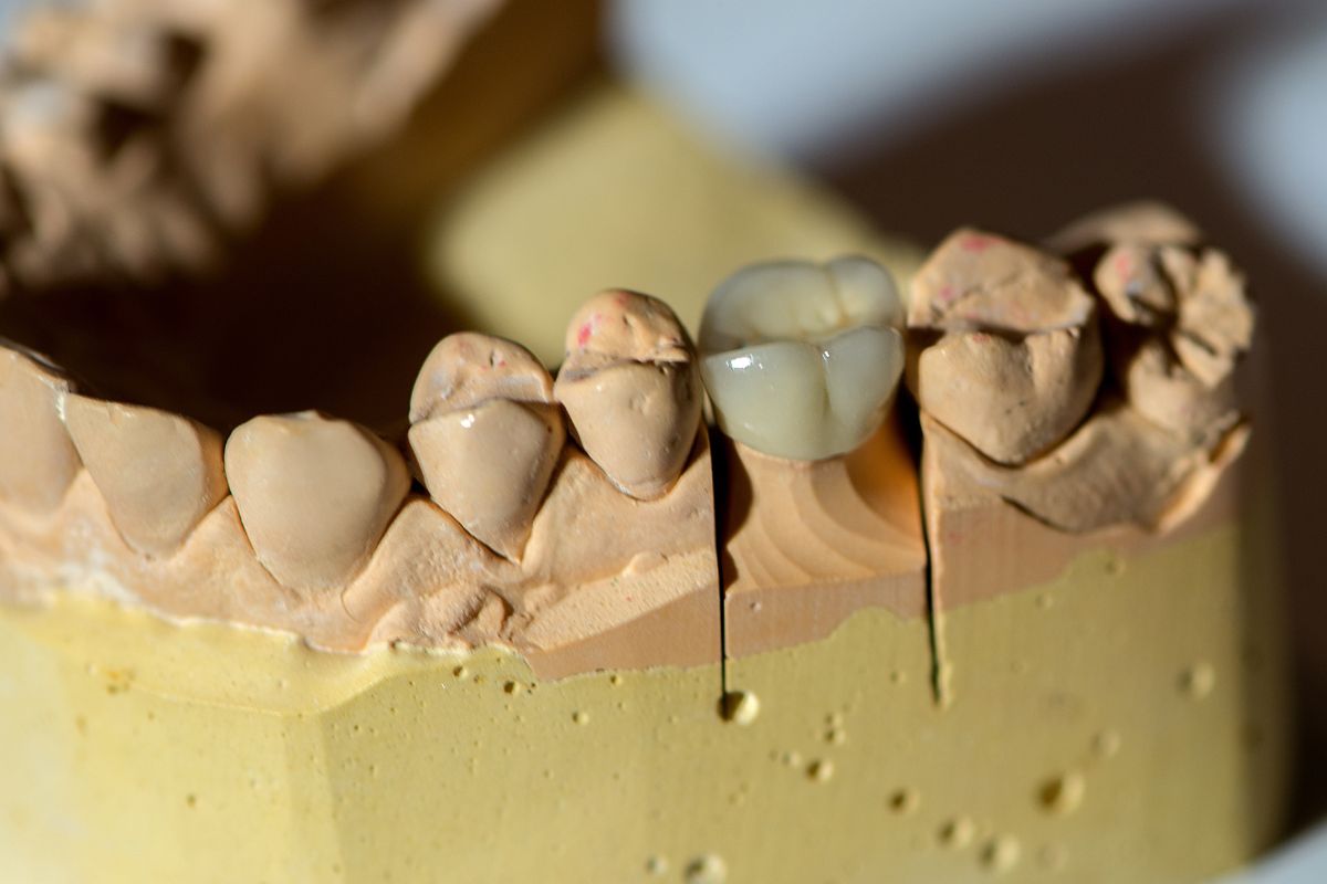 dental crown