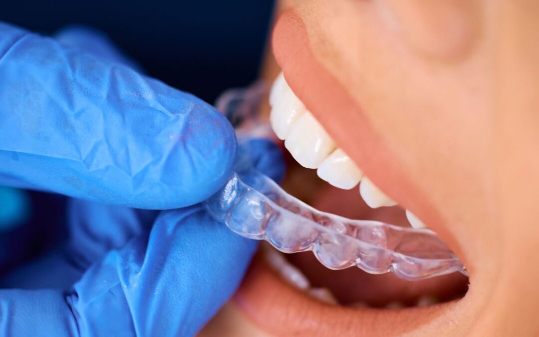 Can Invisalign Effectively Fix an Overbite?