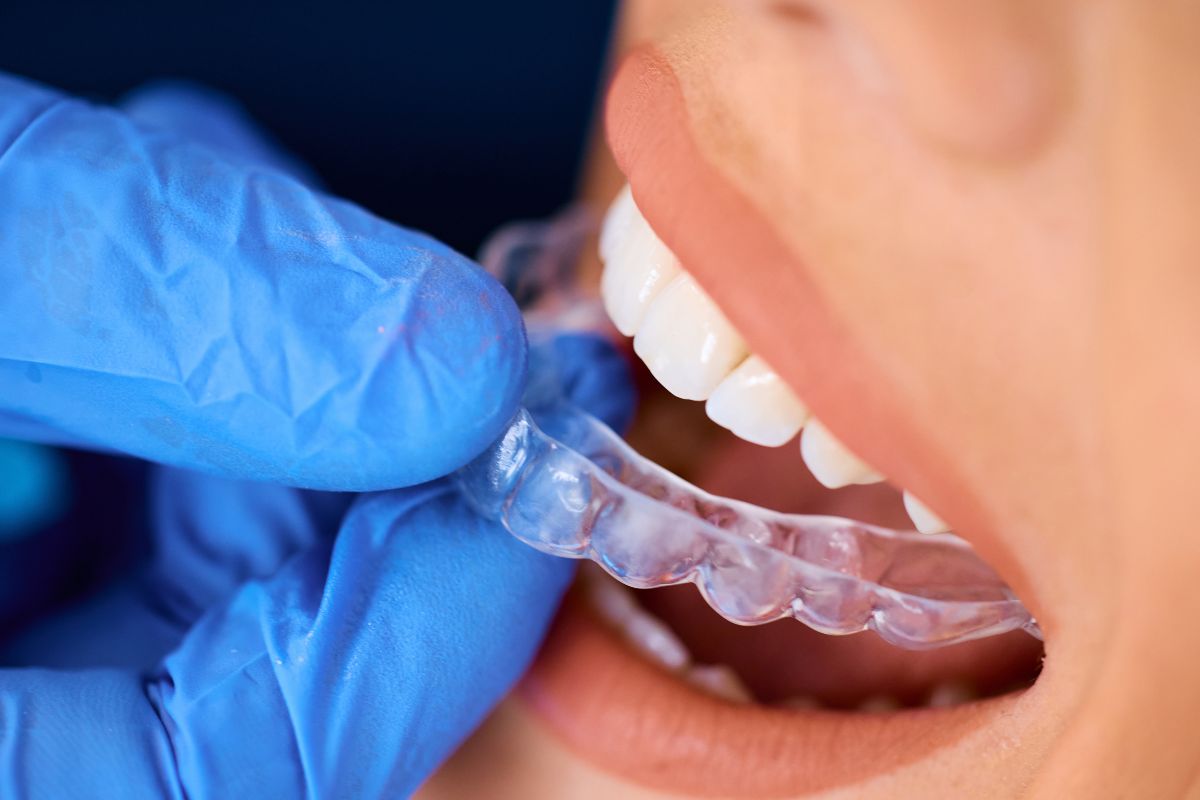 Invisalign treatment