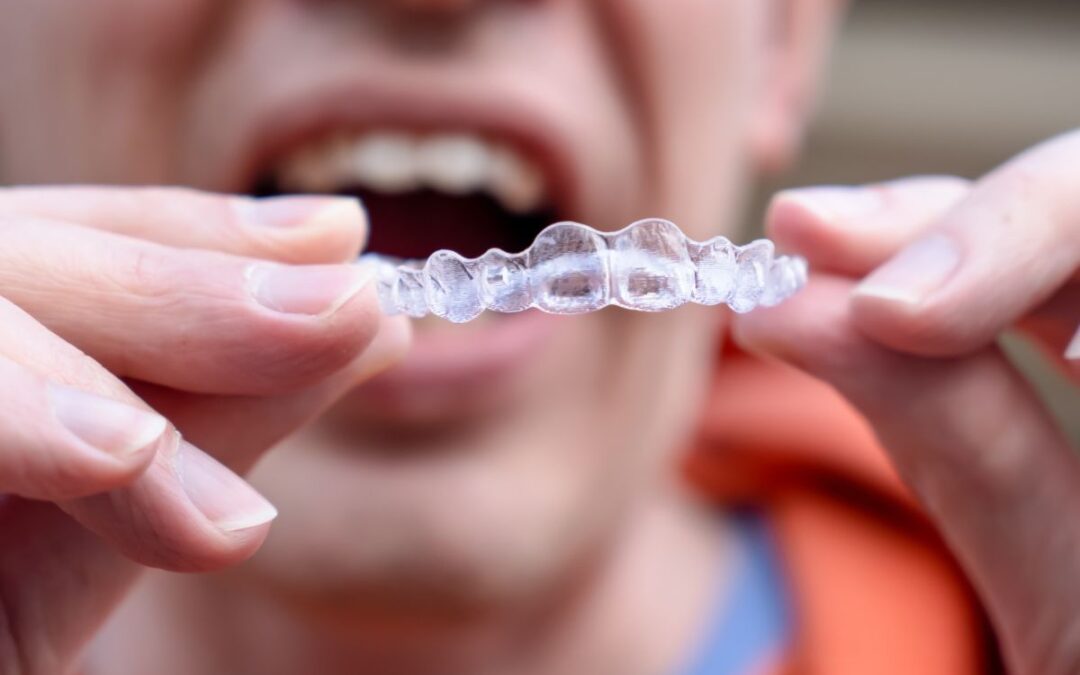 How Can I Tell If My Clear Aligners Are Effectively Straightening My Teeth?