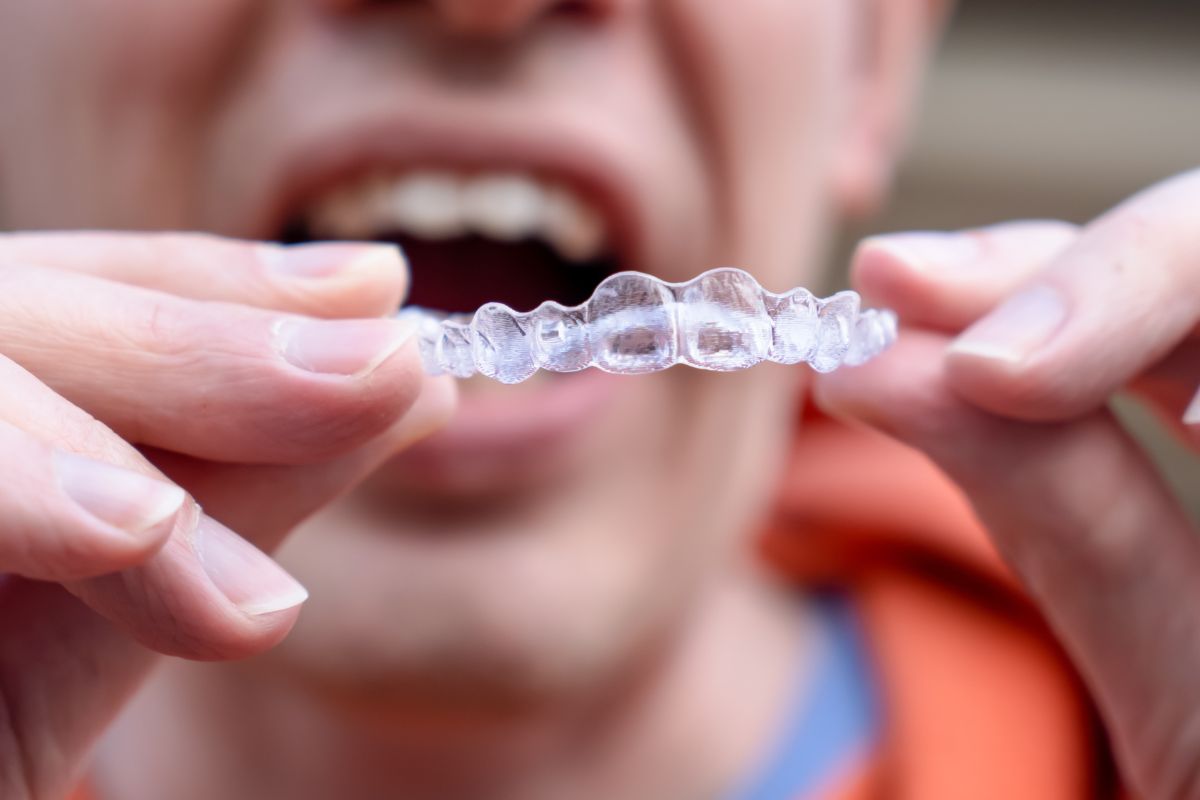 invisalign aligners