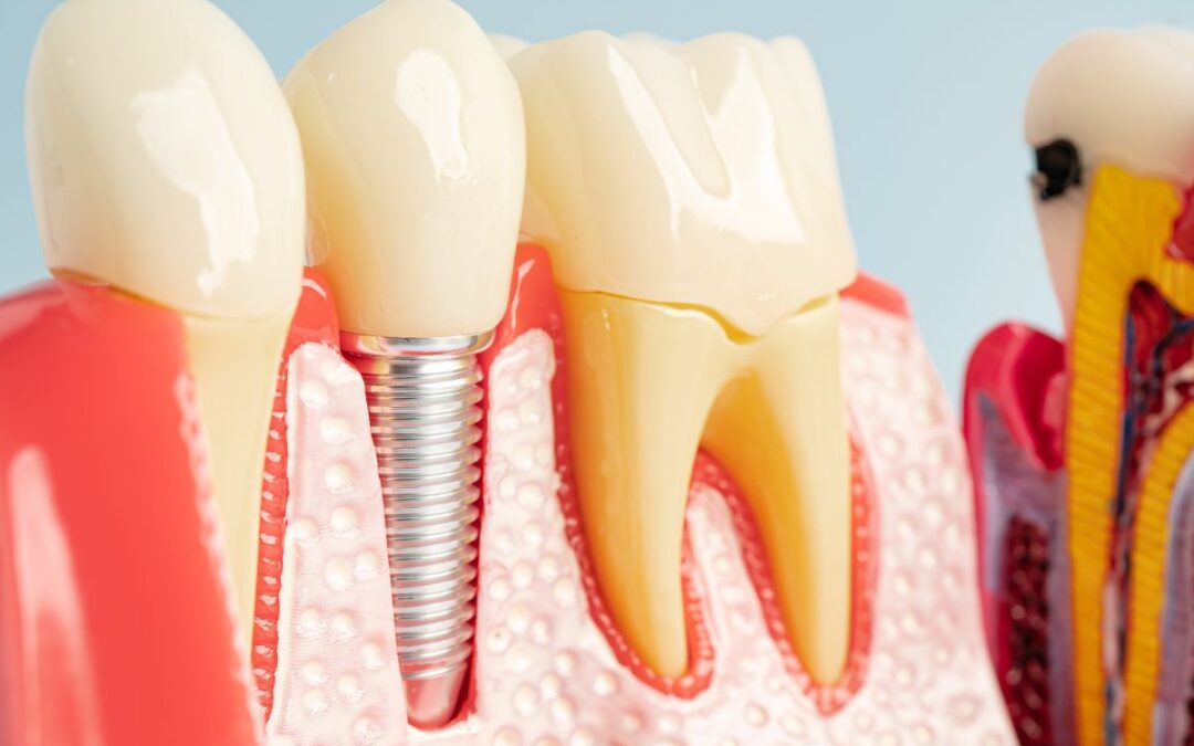 Is Your Dental Implant Infected? Key Symptoms to Watch For