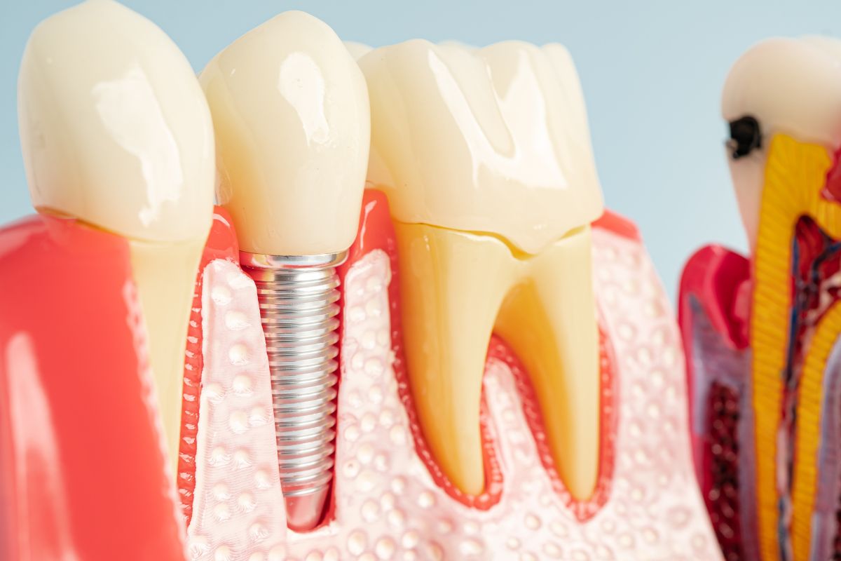 infected dental implants