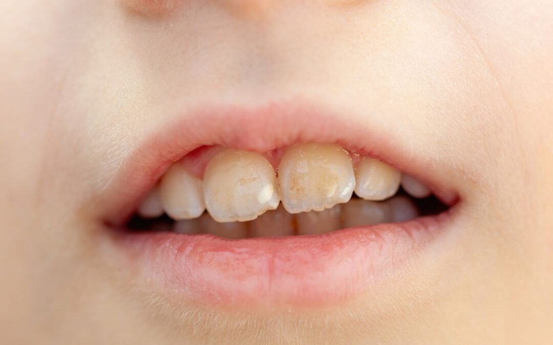 What Causes White Spots on Teeth and How to Fix Them?