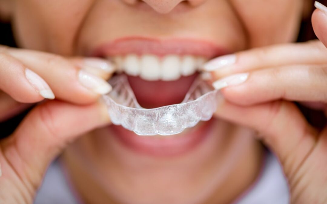 Can Invisalign fix an open bite?