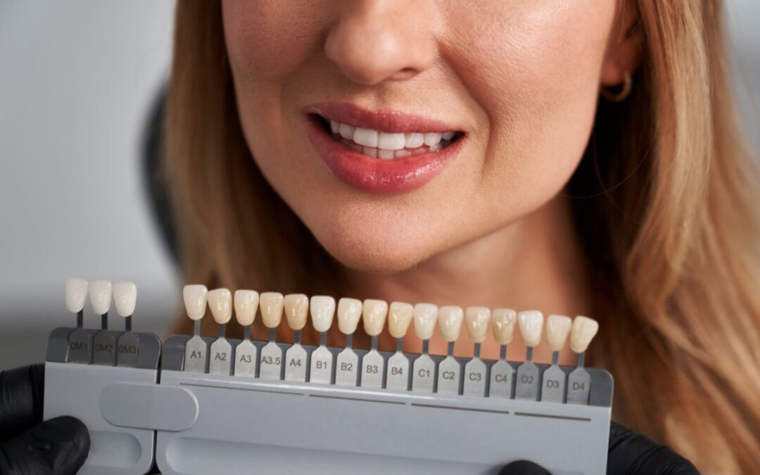 Can You Whiten Teeth After Getting Veneers?