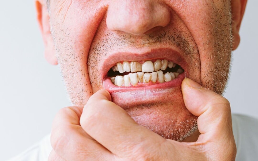 What Makes Teeth Turn Black in Adults?