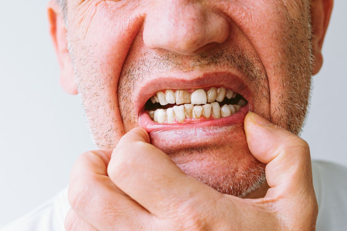 Black Teeth in Adults