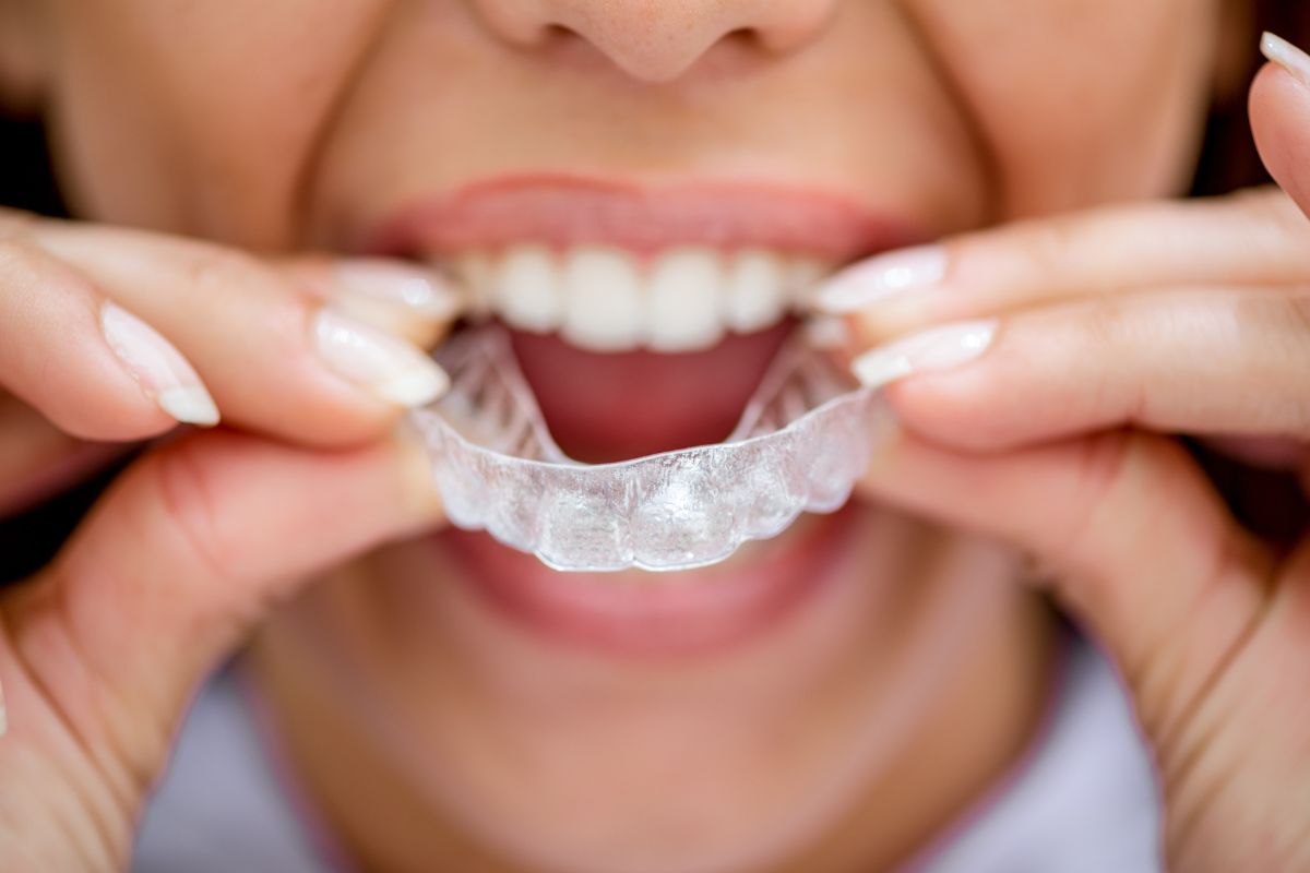 Invisalign Effective for Open Bite Correction