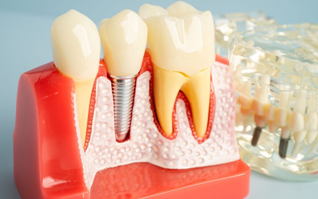 How Do You Fix Bone Loss Around Dental Implants?