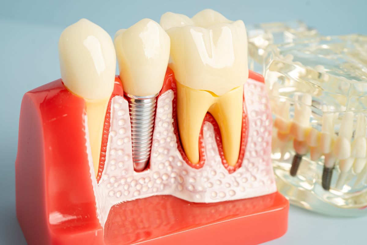Fix Bone Loss Around Dental Implants