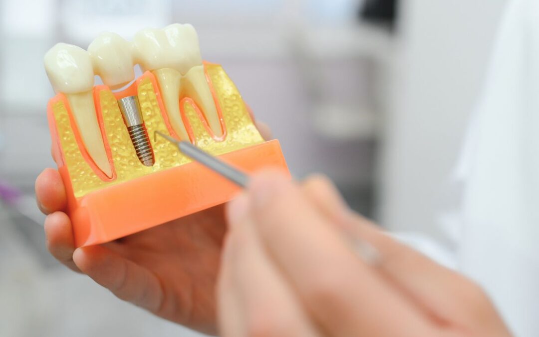 Can You Get Dental Implants Without Bone Grafting?