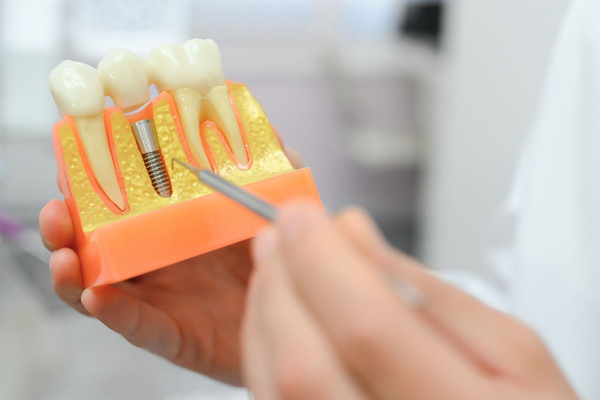 Dental implant model showing titanium screw placement between natural teeth demonstrations.