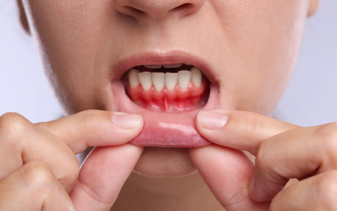 Why Are My Gums Receding? Causes, Treatment, and Prevention