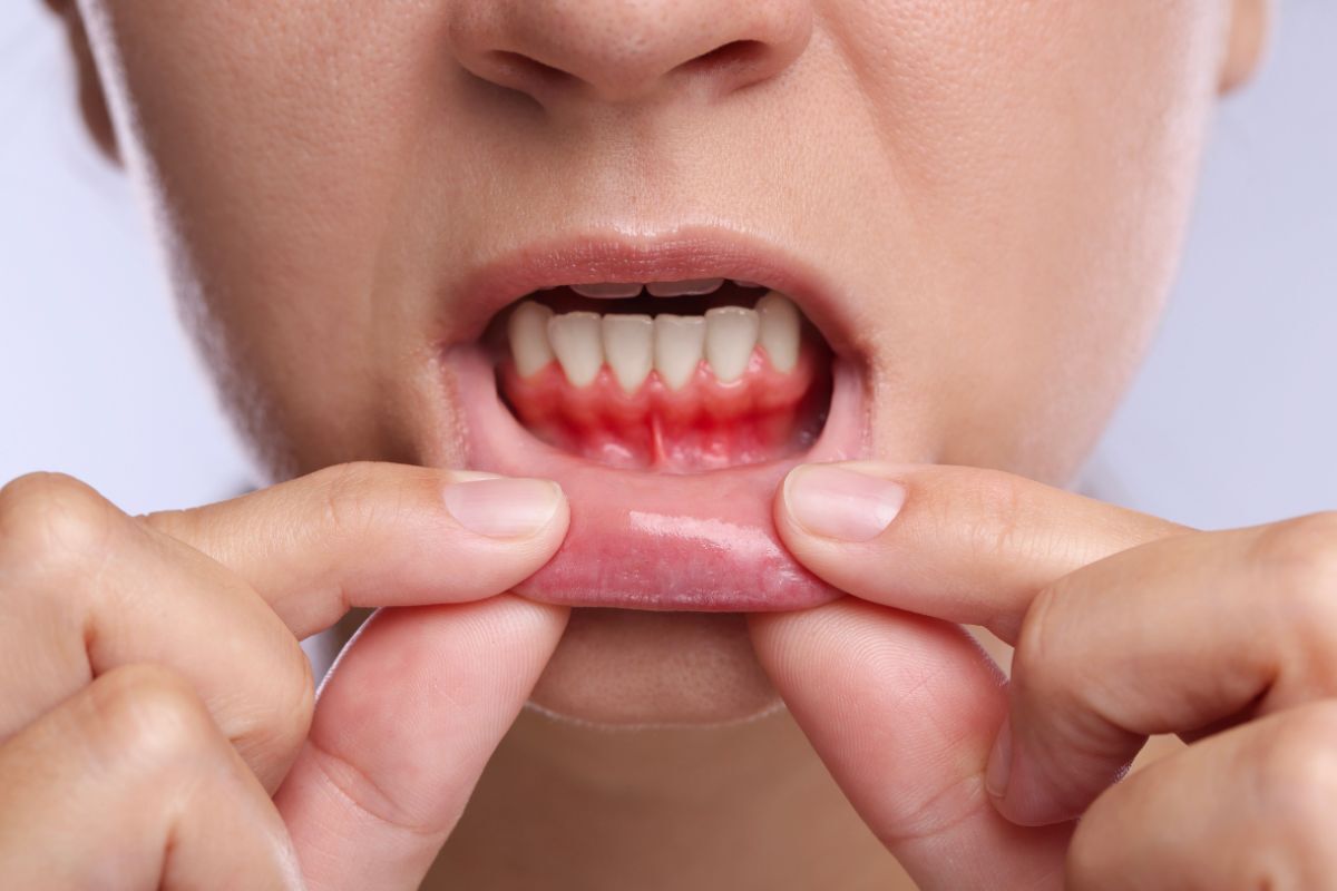 Person showing inflamed and receding gums with visible redness at the gum line.