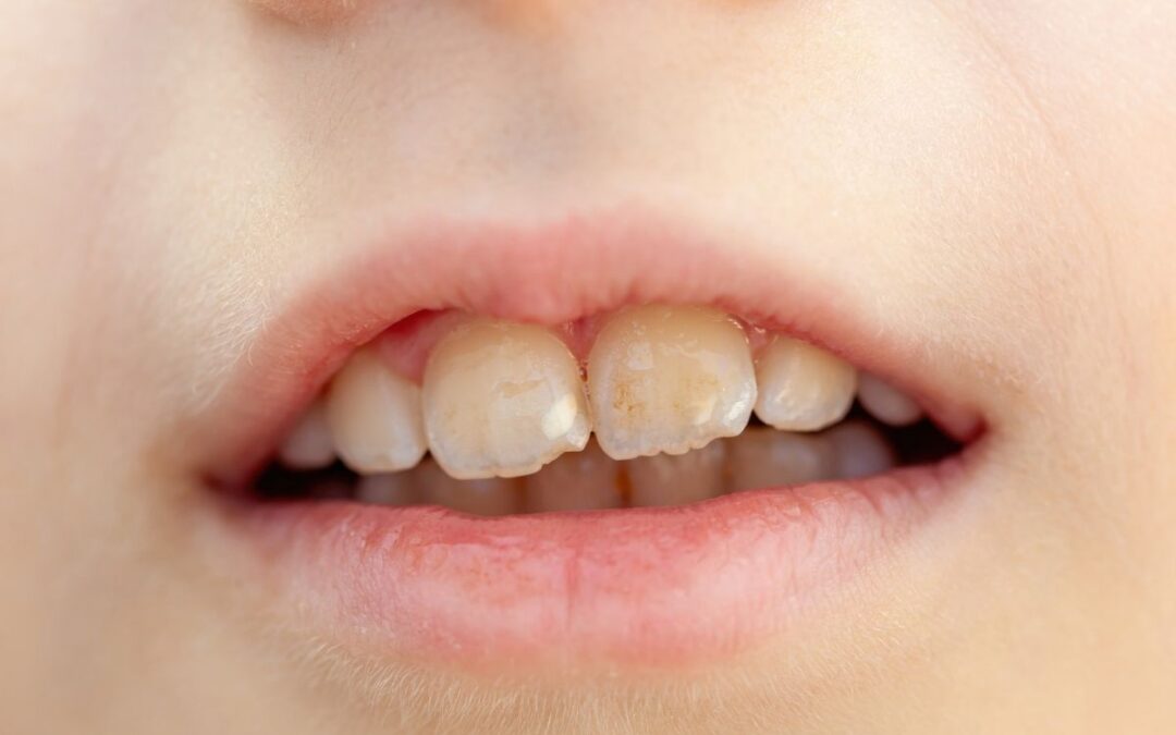 How to Fix a Tooth That Looks Shorter Than the Teeth Around It