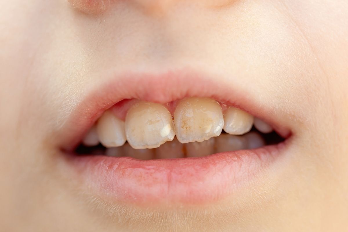 Close-up of a child's upper front teeth showing one shorter tooth next to normal-length teeth.