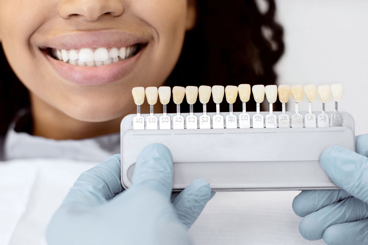dental veneers